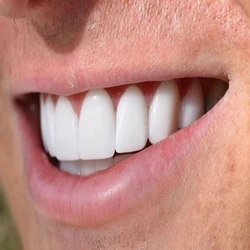 Laminates Veneers