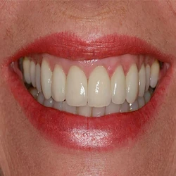 Laminates Veneers
