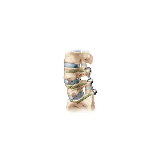 spine-surgery-implants-2.webp