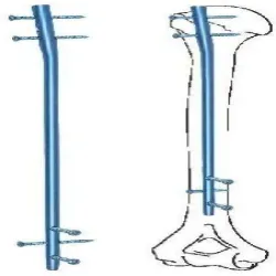 Square Nail For Ulna Dia SS316L Orthopedic Nailing Implant, Size 35mm
